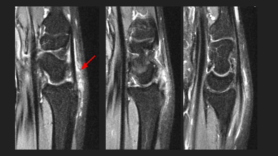 Figure 2 for case extensor pollicis longus tendon ( RID2378 )